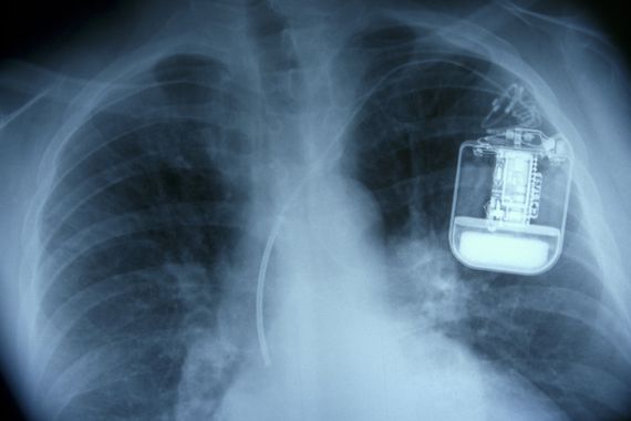 Judge rules pacemaker data can be used against defendant     – CNET