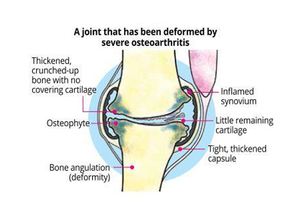 Debunking myths: Cracking joints cause arthritis