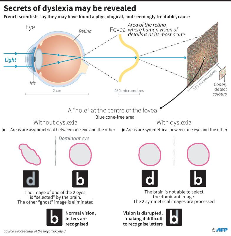 Scientists may have found a cause of dyslexia