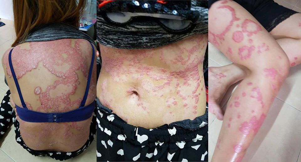 Thai woman with psoriasis abandoned by husband, suspended from work