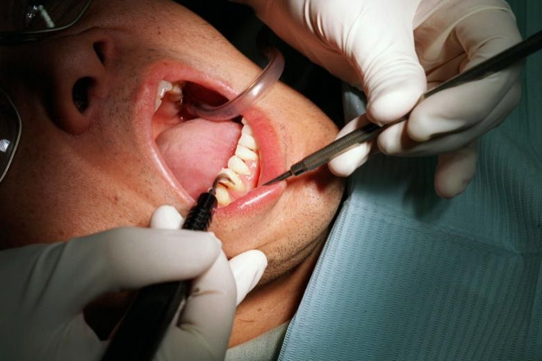 Severe gum disease could be early sign of diabetes and pre-diabetes: Study